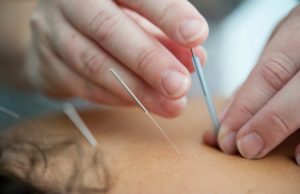 practitioner putting acupuncture needles in woman's back